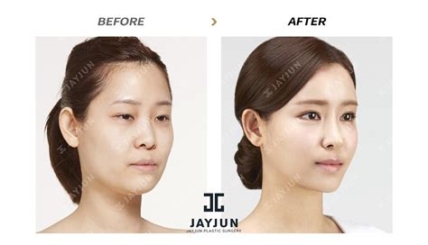 lv plastic surgery korea|best plastic surgery south Korea.